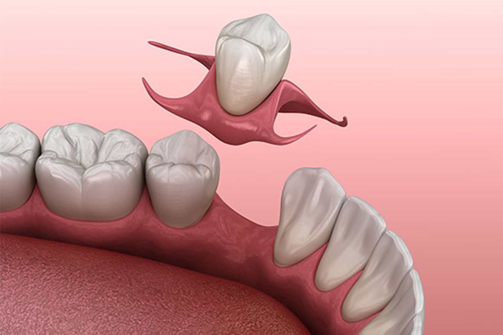 CAD/CAM Zirconia Crowns & Bridges