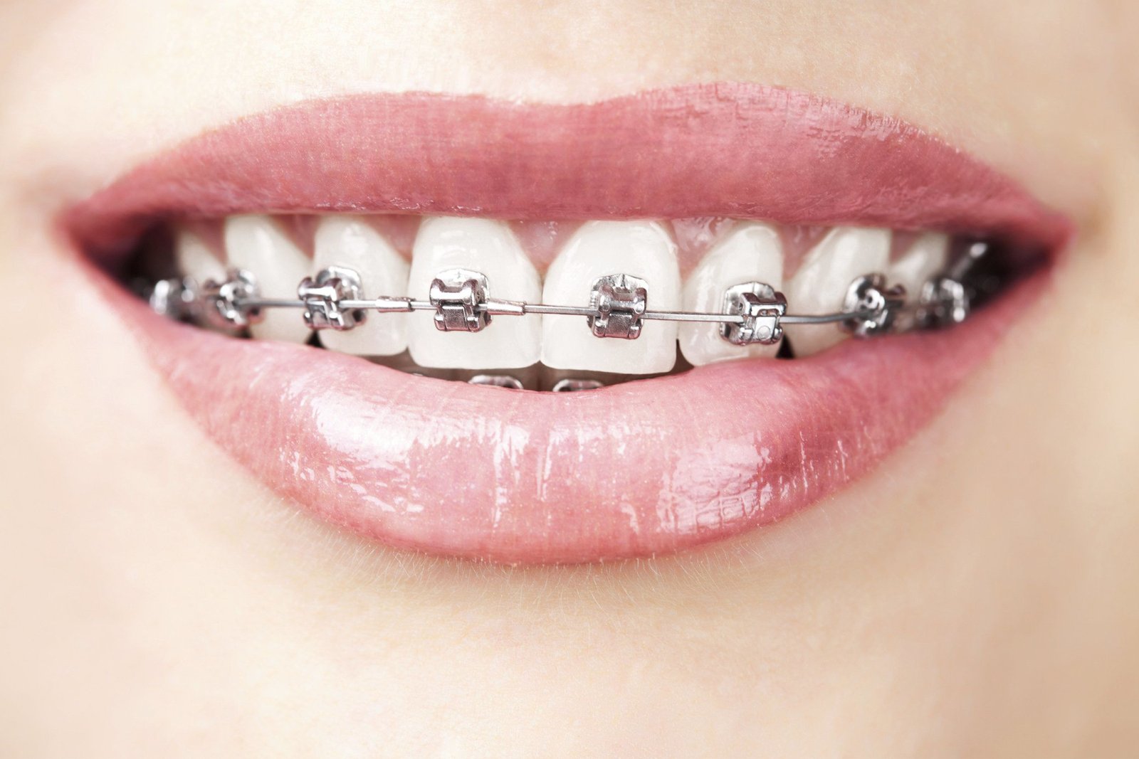 Tooth Extraction & Wisdom Teeth