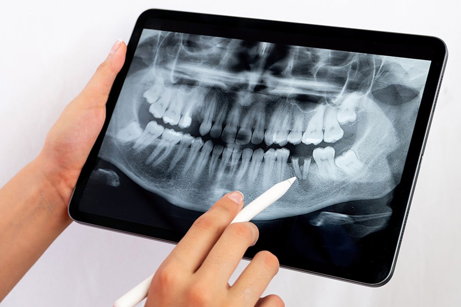 Clear Aligners
