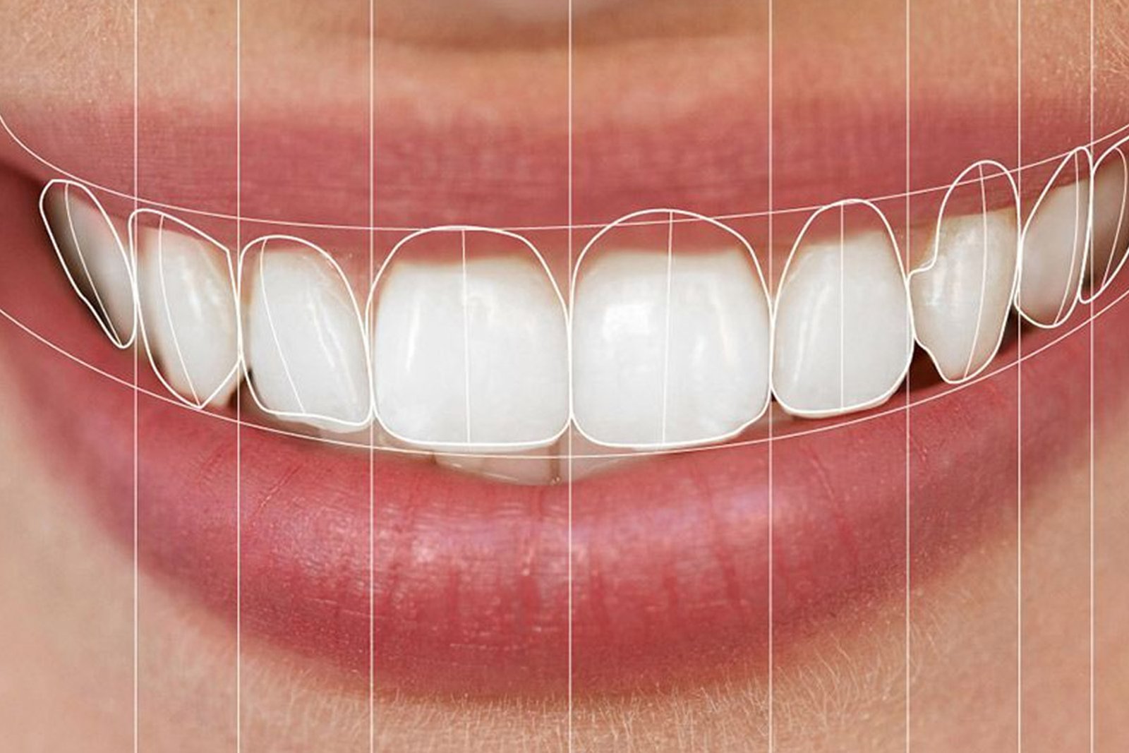 Teeth Whitening (Bleaching)